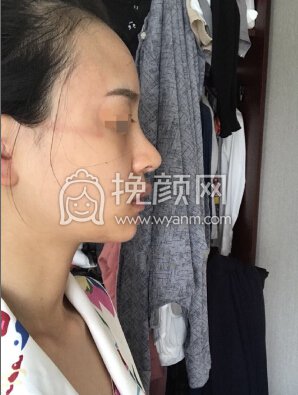 上海百达丽顾清鼻部手术加太阳穴