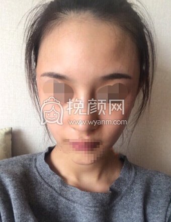 上海百达丽顾清鼻部手术加太阳穴