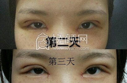 武汉美都医院做的微创精切+内眼角+提肌