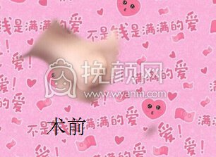 成都娇点李竞医生做的膨体鼻部手术