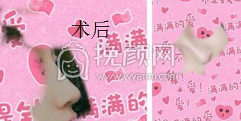 成都娇点李竞医生做的膨体鼻部手术