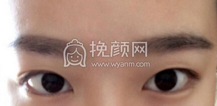 秦皇岛巧致整形医院潘医生做的埋线+抽脂