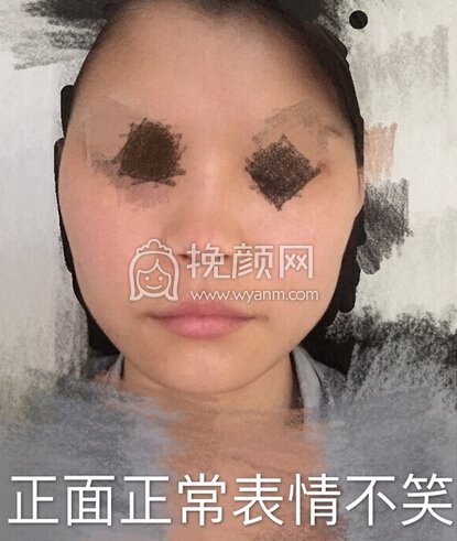 初鼻想做鼻部手术,预算是四万内,追求自然款