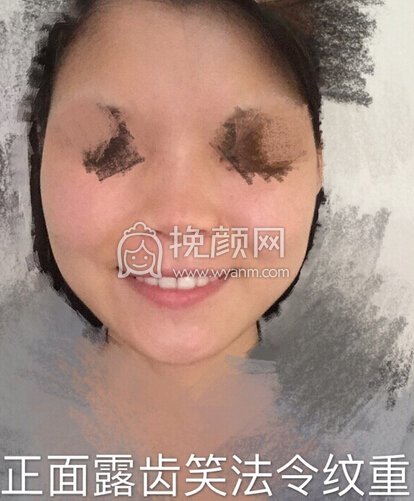 初鼻想做鼻部手术,预算是四万内,追求自然款