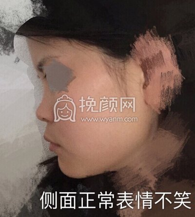 初鼻想做鼻部手术,预算是四万内,追求自然款