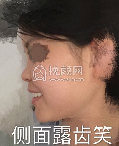 初鼻想做鼻部手术,预算是四万内,追求自然款