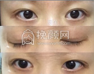 武汉天佑医院邵芳医生韩式三点