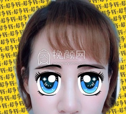 福州爱美尔医院黄振银院长做的鼻部手术
