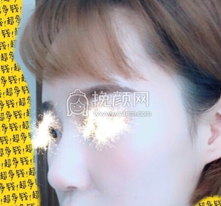 福州爱美尔医院黄振银院长做的鼻部手术