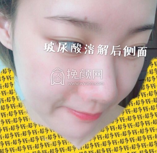 福州爱美尔医院黄振银院长做的鼻部手术