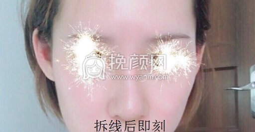 福州爱美尔医院黄振银院长做的鼻部手术