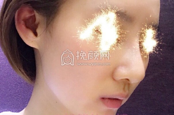 福州爱美尔医院黄振银院长做的鼻部手术