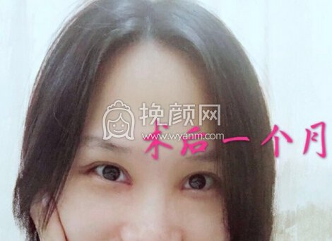 武汉协和杨杰全切+内眼角