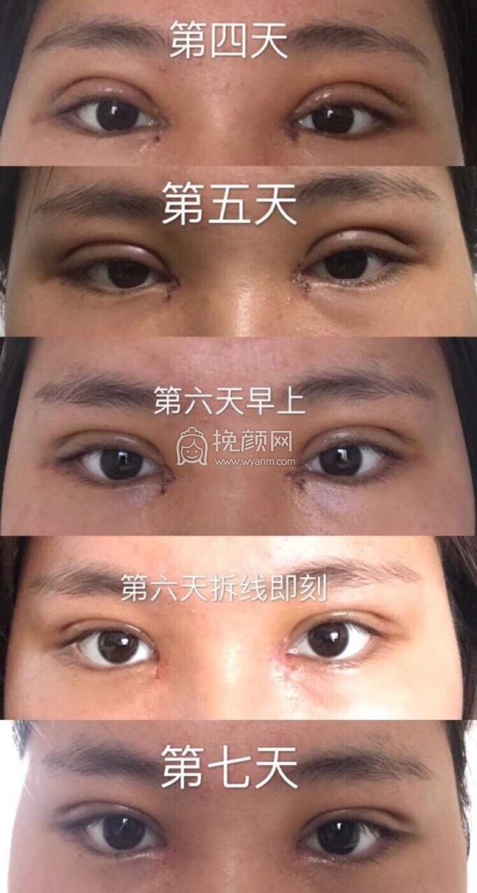 长沙伊美刘芳全切+内眼角