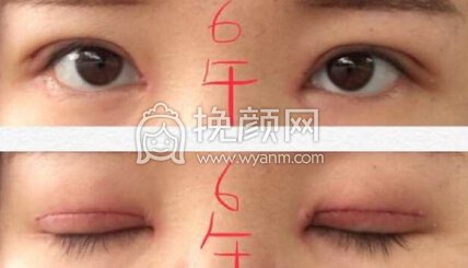 成都良好美研徐彬医生双眼皮+开眼角+提肌