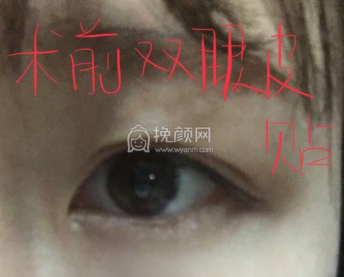 成都良好美研徐彬医生双眼皮+开眼角+提肌