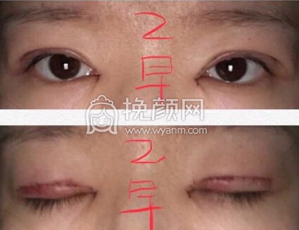 成都良好美研徐彬医生双眼皮+开眼角+提肌