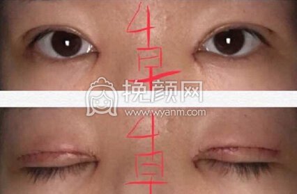 成都良好美研徐彬医生双眼皮+开眼角+提肌