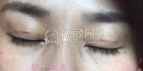 台江中医院黎护忠多点定位微创+上睑下垂调整