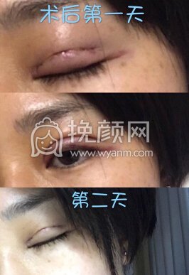 台江中医院黎护忠多点定位微创+上睑下垂调整