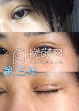 台江中医院黎护忠多点定位微创+上睑下垂调整