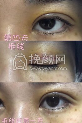 台江中医院黎护忠多点定位微创+上睑下垂调整