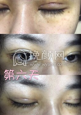 台江中医院黎护忠多点定位微创+上睑下垂调整