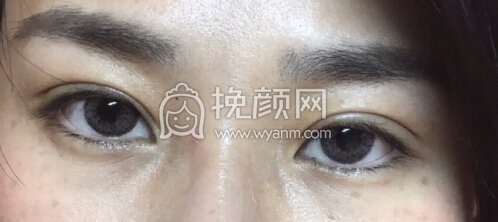 台江中医院黎护忠多点定位微创+上睑下垂调整