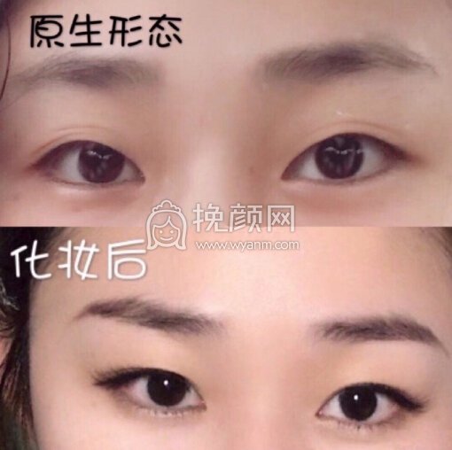 台江中医院黎护忠多点定位微创+上睑下垂调整