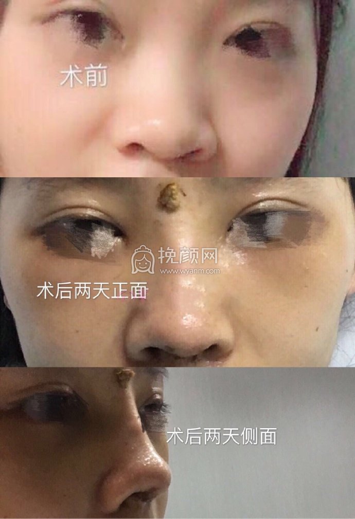 武汉卓美整形王海平做的全肋,山根和鼻头