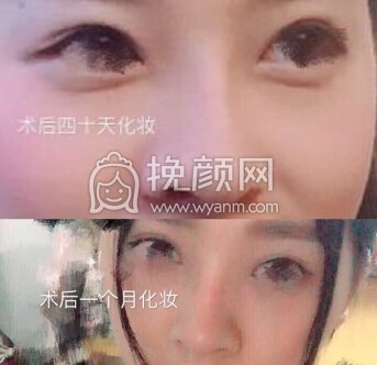 武汉卓美整形王海平做的全肋,山根和鼻头