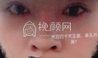 武汉卓美整形王海平做的全肋,山根和鼻头