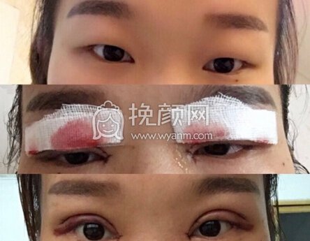 福建龙岩欧菲整形院长做的全切+开眼角