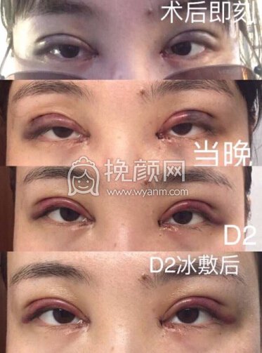 武汉天佑医院李芸医生做的三点+内眼角
