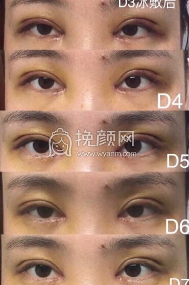武汉天佑医院李芸医生做的三点+内眼角