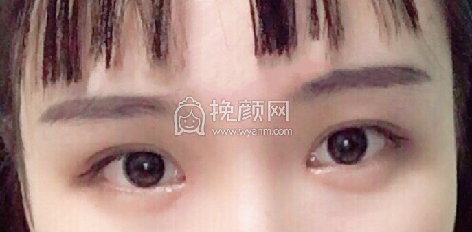 武汉天佑医院李芸医生做的三点+内眼角