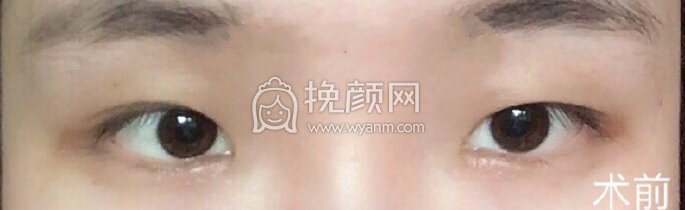 武汉天佑医院李芸医生做的三点+内眼角