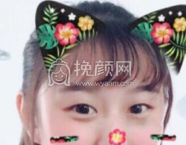 西安丽樽医疗美容郭向阳医生全切双眼皮+内眼