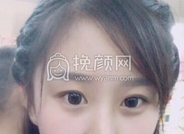 西安丽樽医疗美容郭向阳医生全切双眼皮+内眼