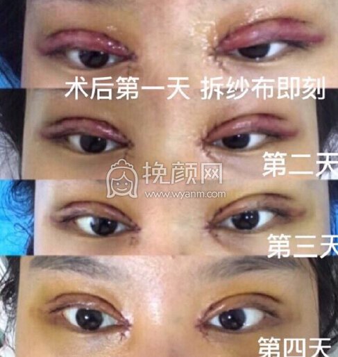 西安丽樽医疗美容郭向阳医生全切双眼皮+内眼