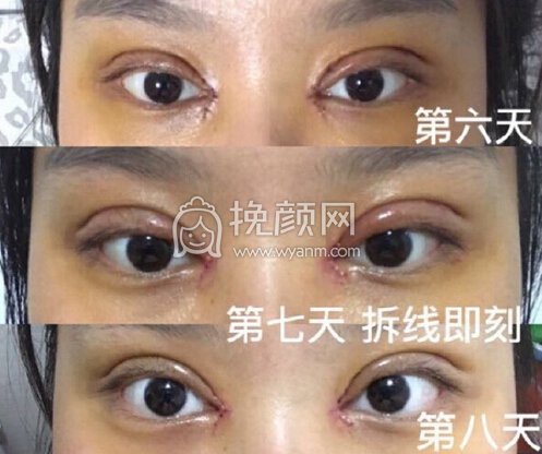 西安丽樽医疗美容郭向阳医生全切双眼皮+内眼