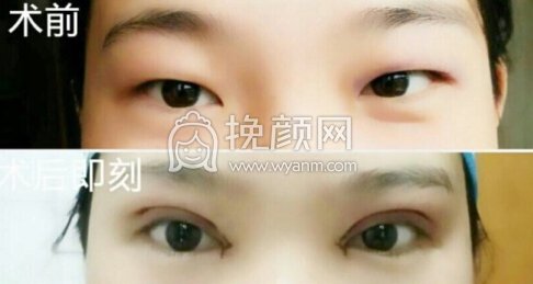 临沂市皮肤病医院宋晓非双眼皮全切+开眼角