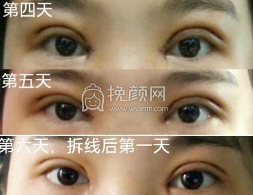 临沂市皮肤病医院宋晓非双眼皮全切+开眼角