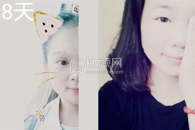 临沂市皮肤病医院宋晓非双眼皮全切+开眼角