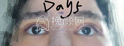 南昌胡博士整形医院胡琼华医生做的全切+眼角