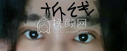 南昌胡博士整形医院胡琼华医生做的全切+眼角