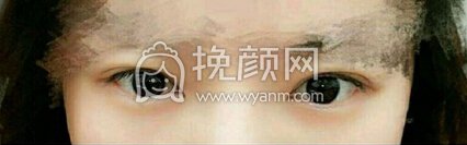 南昌胡博士整形医院胡琼华医生做的全切+眼角