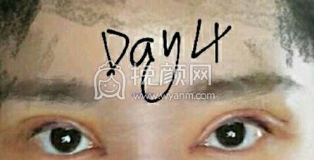 南昌胡博士整形医院胡琼华医生做的全切+眼角