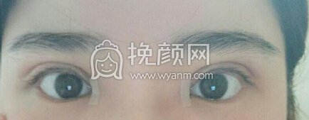 南昌胡博士整形医院胡琼华医生做的全切+眼角