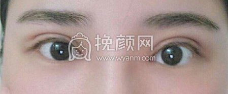 南昌胡博士整形医院胡琼华医生做的全切+眼角